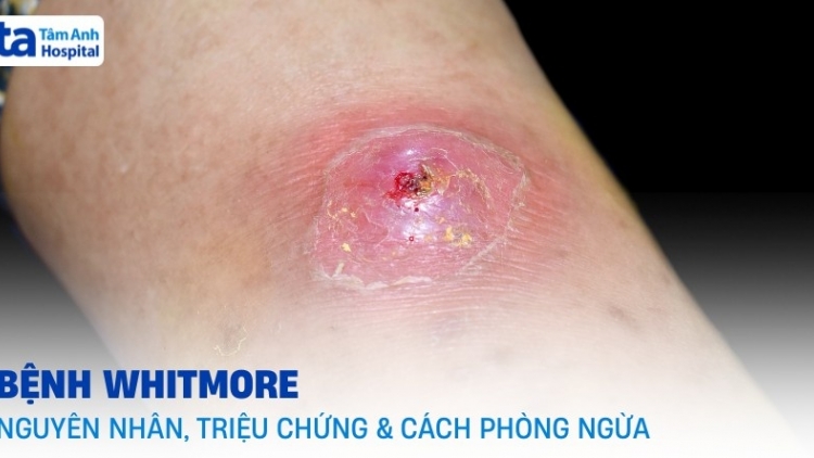 Ngon tô thứ 4 mự 29 căm bườn 4 pì 2026: Bệnh Guýt –mo cánh pưng luông pùn chự phong vện ník