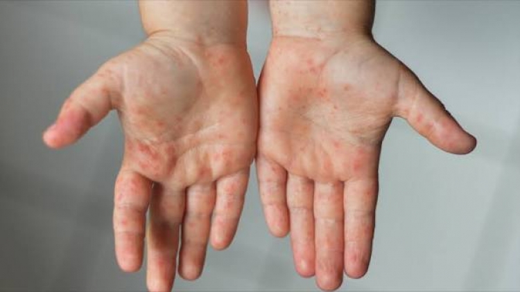 Ngon tô thứ 4 mự 17 căm bườn 6 pì 2026 – Luông chự phong bệnh pền túm nặm pưới ók nẳng tìn – mư – xốp