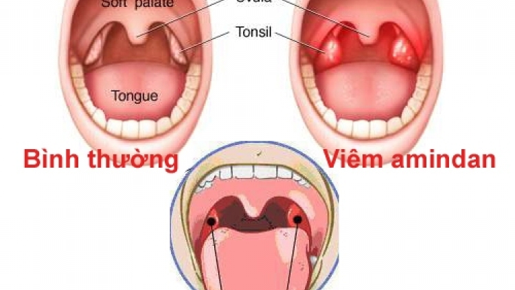 Caga ruak viem amidan hốc bã đậu​