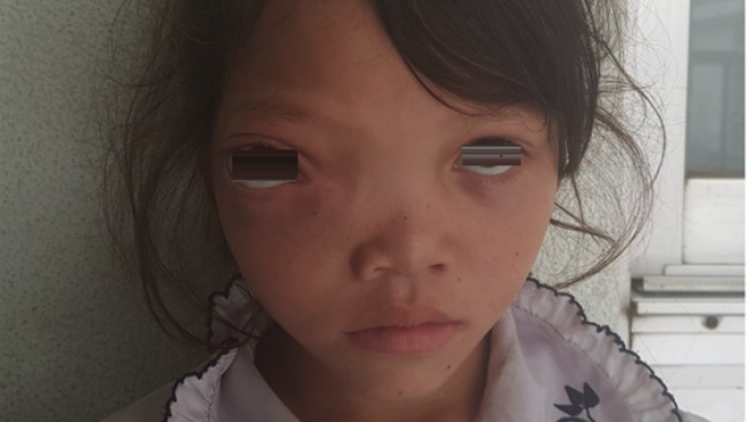 TPHCM: Bệnh viện Chợ Rẫy ruốch liêm choom đoọng ha n’đil p’niên acoon cóh Ca Dong crêê khối u bhrợ cắh liêm crêê cóh móh mặt