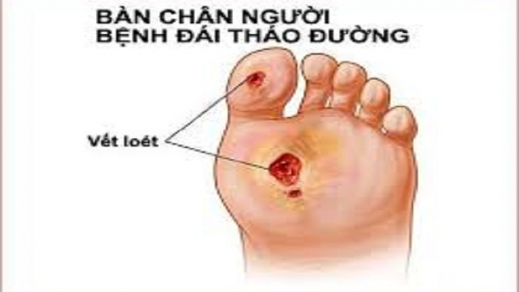 pảnh púng vì pẹ