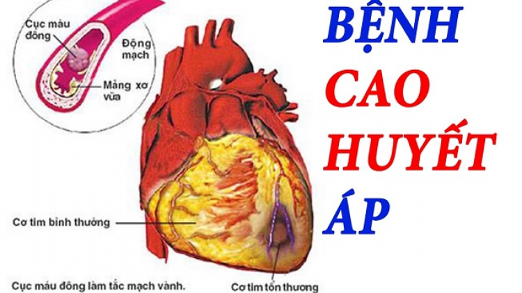 Huyết áp pháo hang- nhủng pẻnh tzấu tải miền cào khzăm tzòi nản chào tầu