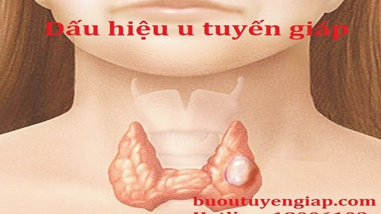 Tziaz tuz ung thư tuyến giáp hít thôz pút