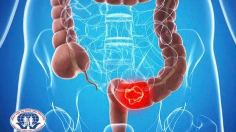 UNG THƯ TRỰC TRÀNG - ĐỢ C’LEH CRÊÊ TA HA VIL