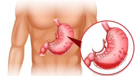 TATUAK DREI BREI KA BRUK PANDIK TIAN GUEL