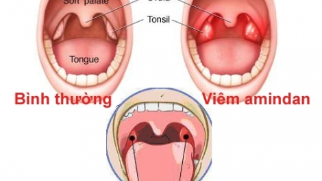 Caga ruak viem amidan hốc bã đậu​