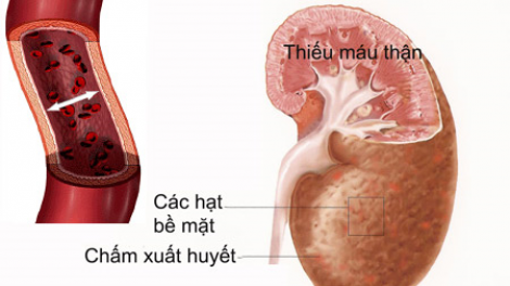 Njauk caik hatai haong biến chứng tim mạch angaok manuac urang ruak ma-ik saradang