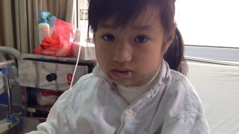 Bé gái bị biến dạng mặt vì căn bệnh hiểm nghèo