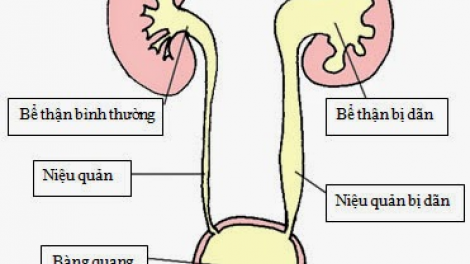 Có 10 triệu đồng, bé Nghĩa sẽ giữ được thận bên trái