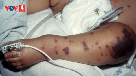 NGÀNH Y TẾ K’ĐƯƠI MOON T’BHLÂNG LÊY CHA MÊÊT, ZÊL CHA GROONG CR’AY VIÊM A’BỤC MÔ CẦU