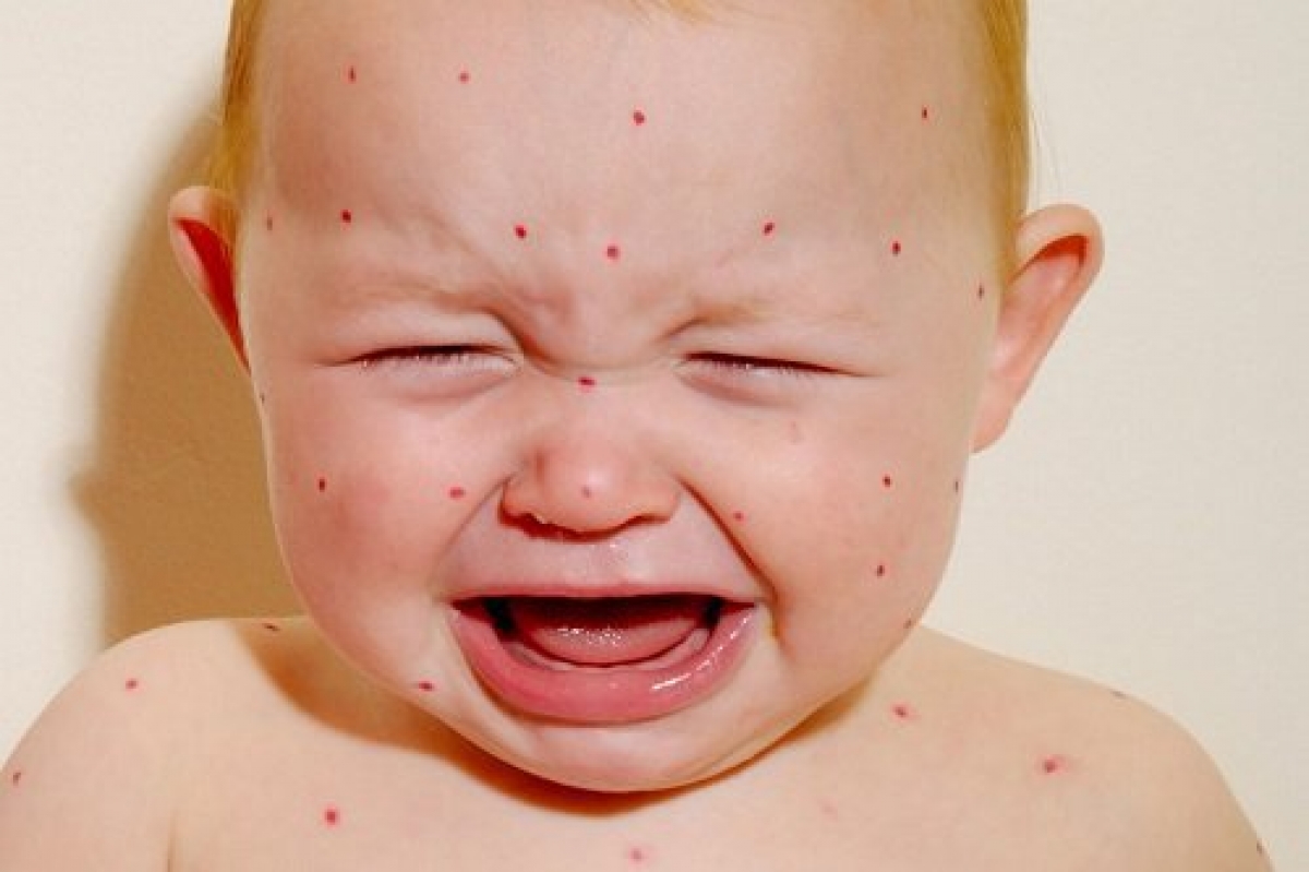 Cách phòng tránh bệnh sởi hiệu quả nhất là tiêm vaccine 