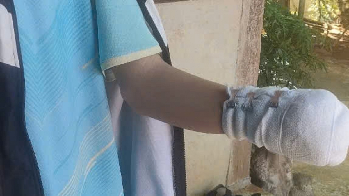 Tai nạn do pháo nổ khiến học sinh N.Đ.T (15 tuổi) thương tích cả bàn tay.